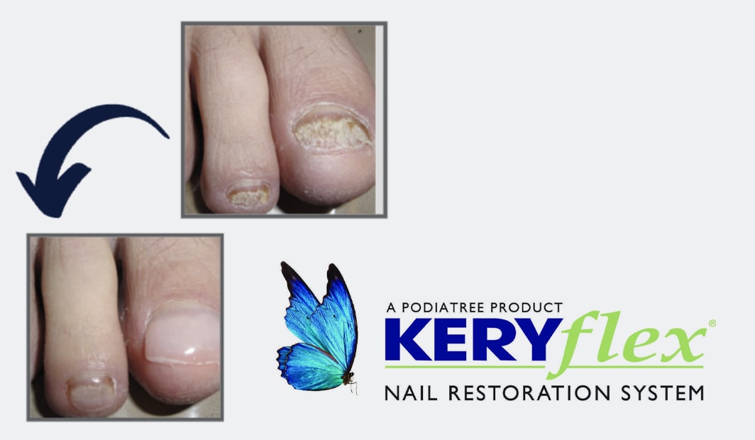 Melbourne Keryflex Nail Treatment